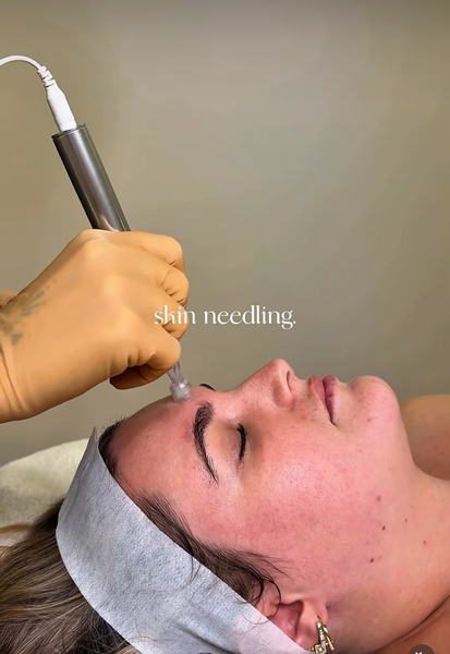 Black Friday Skin Needling Package