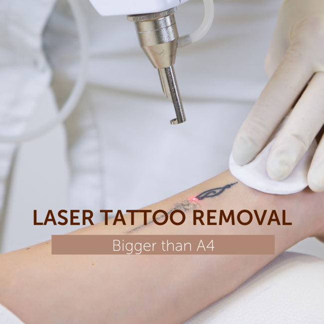 Laser Tattoo Removal - Bigger than A4