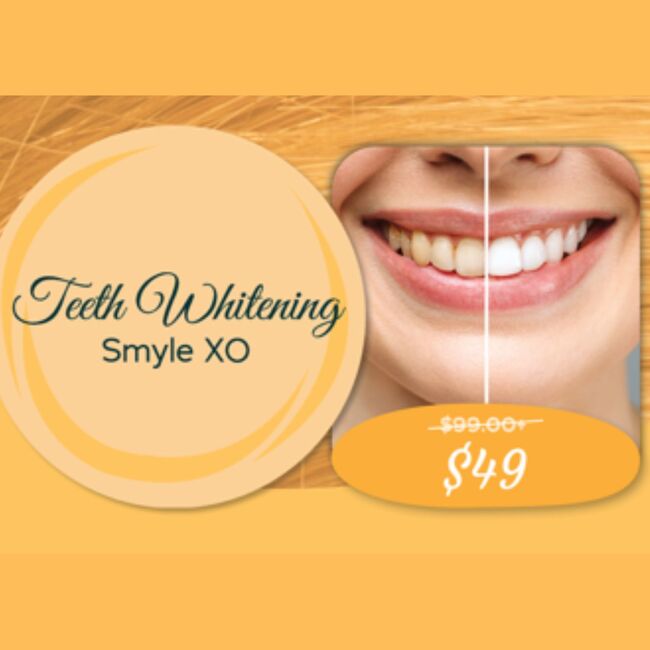 *Extend Your Summer Teeth Whitening - Smyle XO